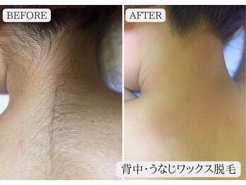 ルミア 函館店(LuMia)/背中・うなじ脱毛★美印象へ!