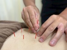 くまはら接骨院 所沢院/鍼で手強い腰痛改善しましょう！