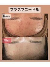 ハイコガオ 中崎町店(HIKOGAO)/プラズマ