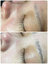 プレジール(Plaisir)/韓国ピーリング×肌管理