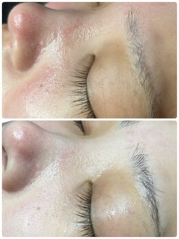 プレジール(Plaisir)/韓国ピーリング×肌管理