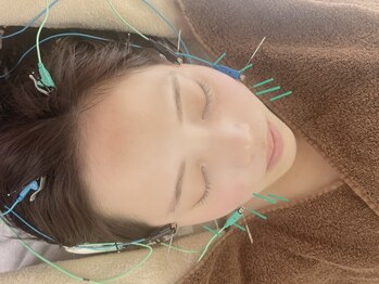 ブリリアント 西宮(Brilliant)の写真/お顔の持続型美容鍼のその訳は!?【帰宅後も日々効果が進む】フェイスライン劇的改善・目元ほうれい線にも◎