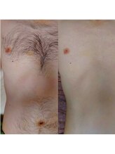 キナリ(kinari)/胸お腹ワックス脱毛