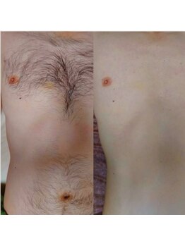 キナリ(kinari)/胸お腹ワックス脱毛