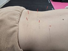 千葉東鍼灸院・整骨院/鍼施術