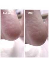 イーロ(iiro)/削りすぎない角質ケア