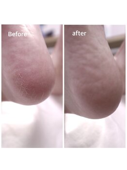 イーロ(iiro)/削りすぎない角質ケア