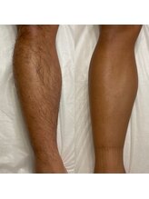 ベルフィーヌボーテ(BELFINE beaute)/脚脱毛4回目！