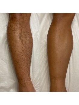 ベルフィーヌボーテ(BELFINE beaute)/脚脱毛4回目！