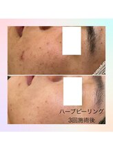 フレイヤビューティー スハダラボ 恵比寿(Freyia Beauty Suhada LABO)/-繰り返すニキビ予防-恵比寿
