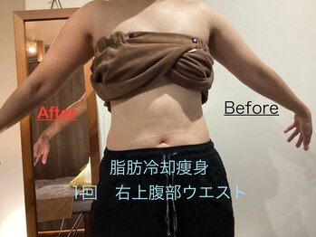 セルリアンブルー(Cerulean Blue)/脂肪冷却痩身の結果
