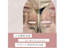 コットンビューティ(cotton.beauty)の雰囲気（水光ピール/プラズマニアで諦めかけたシミもコンシーラー入らず!）