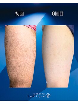 ルミーク(Lumique)/太もも 6回目 症例　O様
