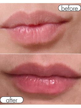 ピンクトーンプログラム 本店(PINK TONE PROGRAM)/ピンクトーン　リップ施術直後