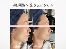 アンドミルル(and Milulu)/【小顔×たるみ改善】生炭酸+光