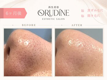 オルディーネ(ORUDiNE)/ 毛穴洗浄ビフォー