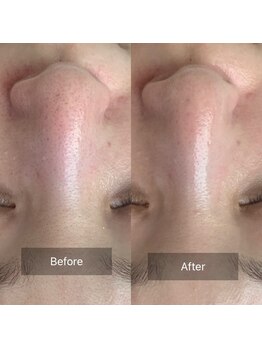 ア ルフレ(A.reflet)/陶肌トリートメント