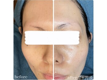 ちらちゅら/クリスティーナ【施術経過】