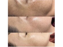 アンジェーム(angeame)/ハーブトリートメント効果