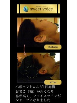 スイートボイス(sweet voice)/痛みの少ない小顔矯正コルギ