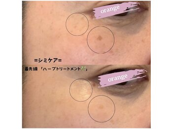 サロンドボーテ オランジュ(salon de beaute Orange)/シミに変化が◎
