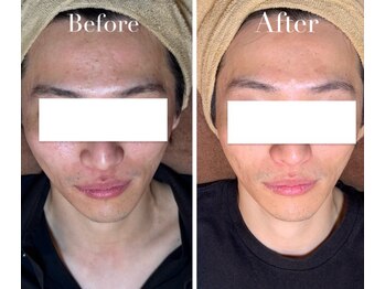 アブニールブリヨン/2BBioハーブピーリング/肌質改善