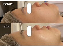 リスタ(RSTA)/【BEFORE/AFTER】