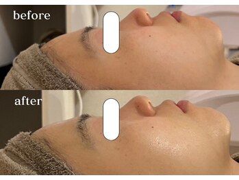 リスタ(RSTA)/【BEFORE/AFTER】