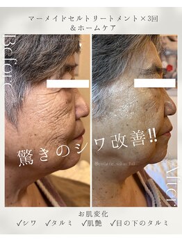 フル(Full)/美肌プログラム