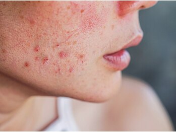 ピービー(PB)の写真/医療提携◇最精鋭ニキビケア【メソプロ(MESOPRO+)×プラズマフェイシャル¥11980】72時間肌運動プログラム