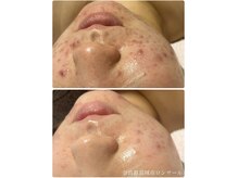 定期的な正しいケアで、繰り返すニキビが鎮静し滑らかな素肌へ