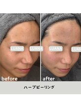 ルアナ 北谷店/ハーブピーリング 《沖縄/北谷》