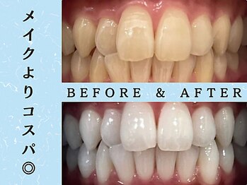ホワイトニングショップ 八王子店/ホワイトニングビフォーアフター