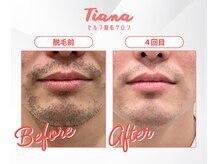 ティアナ 水戸店(Tiana)の雰囲気（セルフでも数回でツルツルに！(セルフ脱毛/全身脱毛/VIO脱毛））