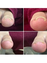 シャンネイルケアサロン(Shan Nail caresalon)/巻いた爪