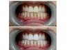 【学割U24】輝く白い歯に／1回で驚きのトーンアップ／歯のホワイトニング