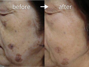 アルカンシエル(arcenciel)/シミ・シワ改善コース