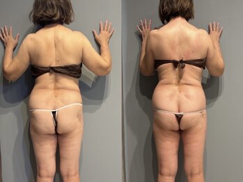 シャイニーシャイニー 金沢店(SHINY/SHINY)/スリムムーヴ痩身症例