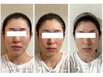 アクアナチュラ(ACQUANATURA)/気になるほうれい線、歪みも♪