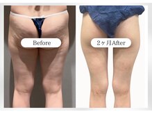 ガーネ 堺店(GARNE)/痩身・下半身痩せ/30代