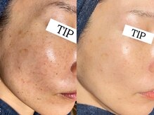 ダリア(Dahlia)/シミケア×ハーブピーリング