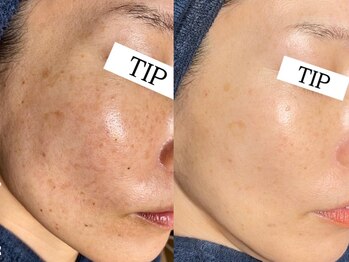 ダリア(Dahlia)/シミケア×ハーブピーリング