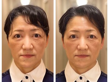 アザブハリーク(AZABU HARIEQ)/症例写真 50代女性（1回施術）