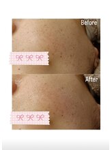 ラ メール(La mer)/★雪花ピール　毛穴、シミ★