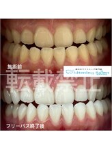 ホワイトニングサロン 福岡天神店/ホワイトニング
