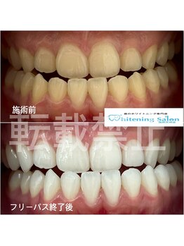 ホワイトニングサロン 福岡天神店/ホワイトニング