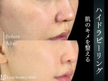 リープ(Leap)/毛穴汚れ一掃ハイドラ