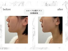 トキ(TOKI)/ユルーフ小顔リフト　直後