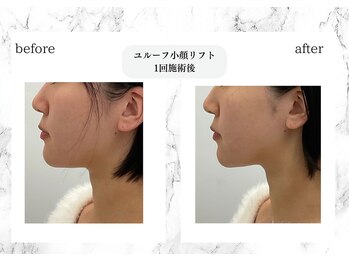 トキ(TOKI)/ユルーフ小顔リフト 直後