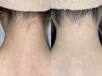 NTエステティック 西条店の写真/【脱毛デビューにオススメ★】こだわり抜いた痛みの少ない本格施術◎お得に理想のツルスベ肌へ導きます♪